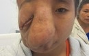 Đang phẫu thuật cho cô gái có khối u mặt “dị“